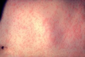 Be aware of measles symptoms in Victoria after case detection
